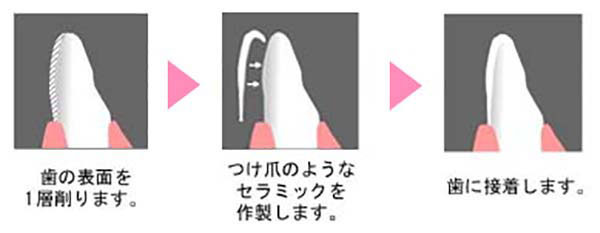 歯の表面を一層削ります。→つけ爪のようなセラミックを作製します。→歯に接着します。