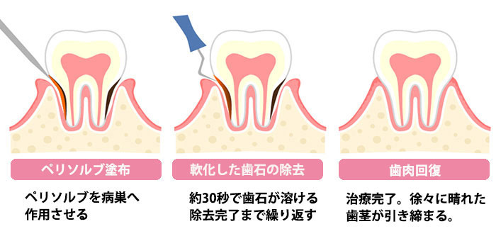 ペリソルブ塗布：ペリソルブを病巣へ作用させる　軟化した歯石の除去：約30秒で歯石が溶ける除去完了まで繰り返す　歯肉回復：治癒完了。徐々に晴れた歯茎が引き締まる。
