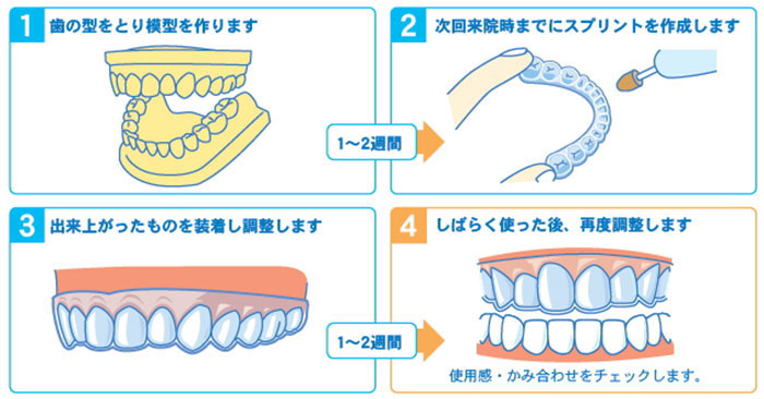 1.歯の型をとり模型を作ります　2.次回来院時までにスプリントを作製します　3.出来上がったものを装着し調整します　4.しばらく使った後、再度調整します